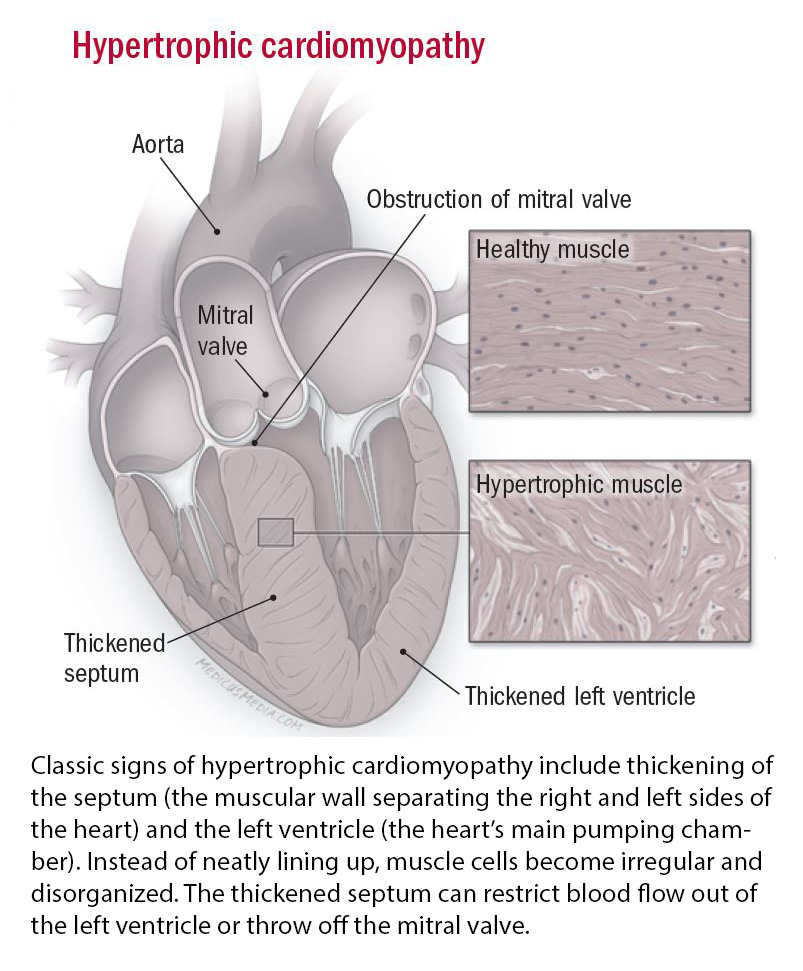 cardiomyopathie-symptomen-diagnose-en-behandeling-harvard-health